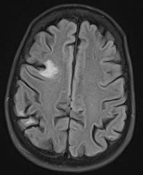 Case 4 61 yo F with seizures, memory loss Workup positive for several autoantibodies (ANA,