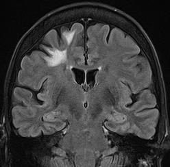 Multiple sclerosis D. Reversible cerebral vasoconstriction syndrome (RCVS) E. Vasculitis Case 4 A.