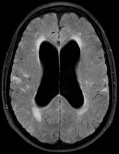 of imaging findings Neuropsychiatric lupus in 50% of SLE; psychosis, stroke, seizure, HA, cognitive
