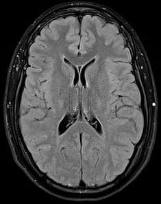 Hypertensive microhemorrhages Cerebral amyloid angiopathy Deposition of β-amyloid in walls of small and mid-sized arteries dementia, hemorrhage Microhemorrhages