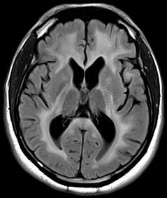 periventricular in hypothalamus, thalamus, brainstem; full thickness of