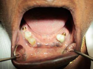Partial Dentures and Implants