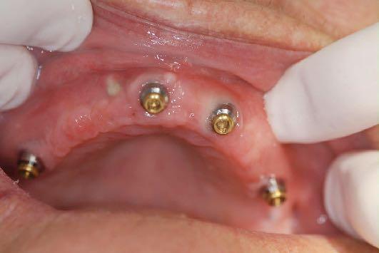 Maxillary Overdenture Need At Least Four Implants To