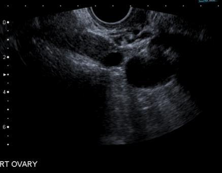 Paraovarian cyst Broad ligament Paramesonephric,