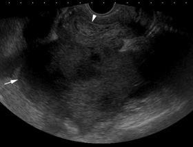 hyperplasia Clear Cell 5% all ovarian cancer Malignant Assoc