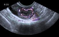 imaging Different approaches to characterising adnexal