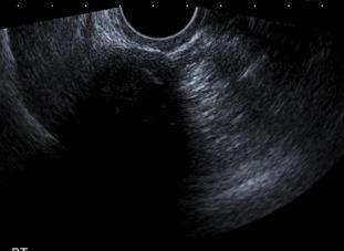 benign Pedunculated fibroid