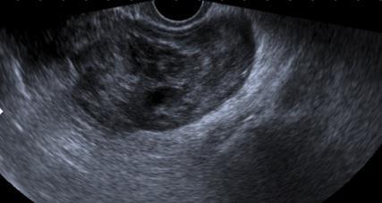 Rare 3% ovarian malignancies Peri /postmenopusal Unilateral - 95% US