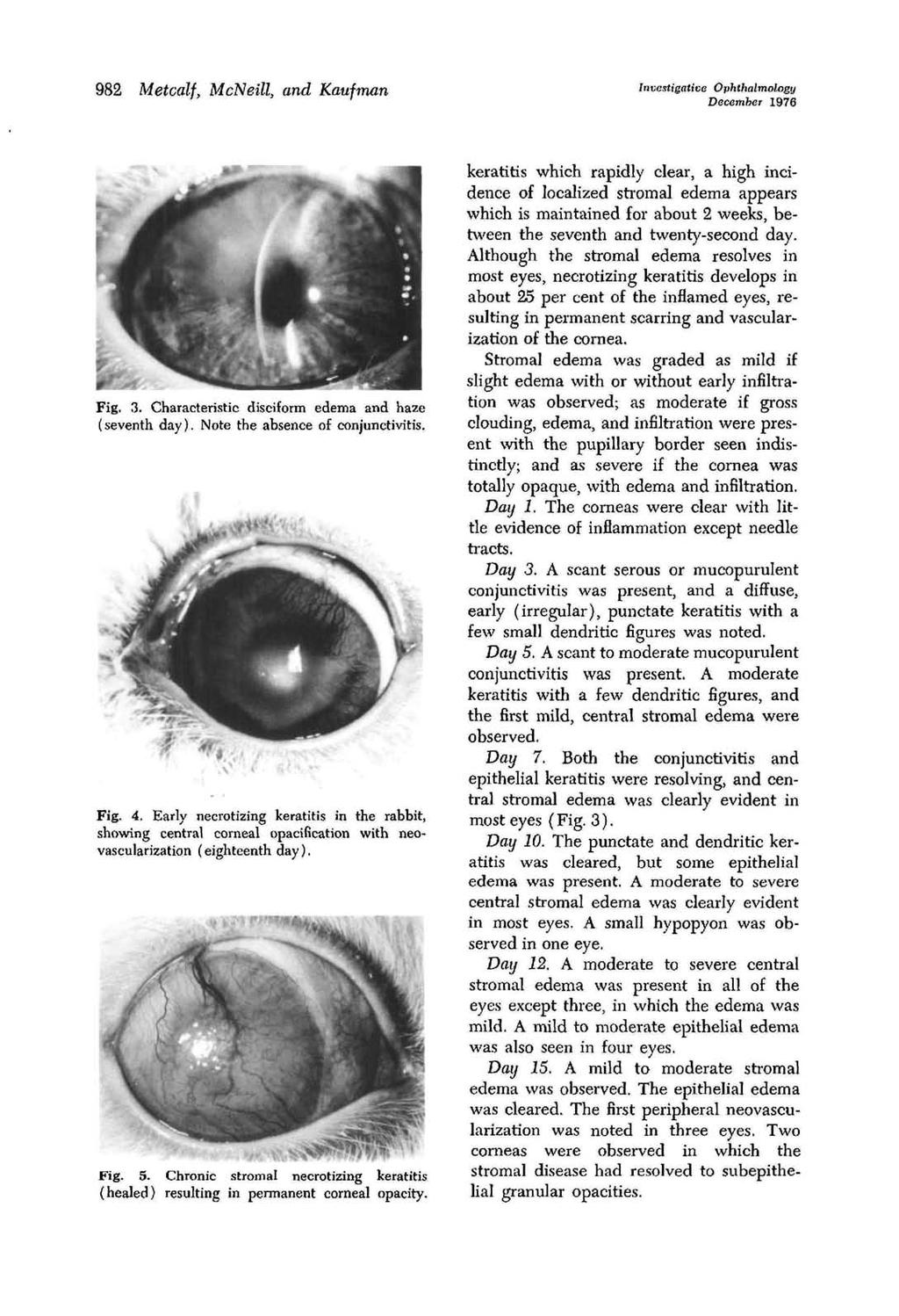 982 Metalj, MNeill, and Kaufman Investigative Ophthalmology Deember 1976 Fig. 3. Charateristi disiform edema and haze (seventh day). Note the absene of onjuntivitis. Fig. 4.
