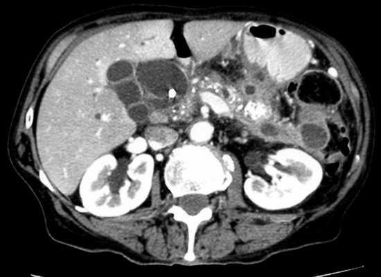 Figure 1. Abdominal computer tomography demonstrating a 7x4.9 cm multi-locular cystic lesion in the head of the pancreas; the largest loculation being 4.1x3.8 cm.