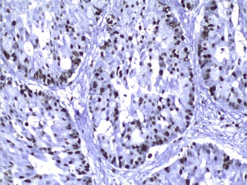 388 Fatma Oz Atalay, Nesrin Ugras et Al nuclear ki67 stained cells was >5% in all 9 of the mucinous cystic pancreatic tumors (8 benign and 1 borderline tumor) in their study (33).