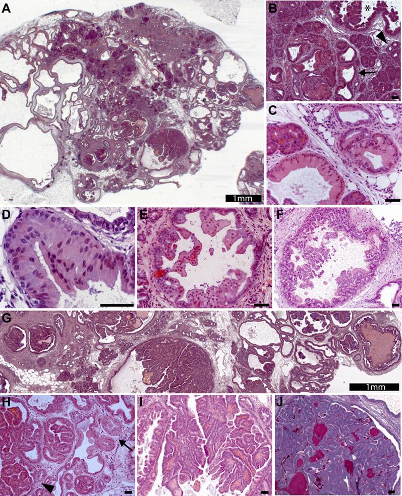 Figure 1. Histology of Different Ductal Lesions in Kras G12D ;Ela-Tgfa Mice (A) Gross morphology reveals replacement of acinar tissue by cysts and various small and large ductal structures.