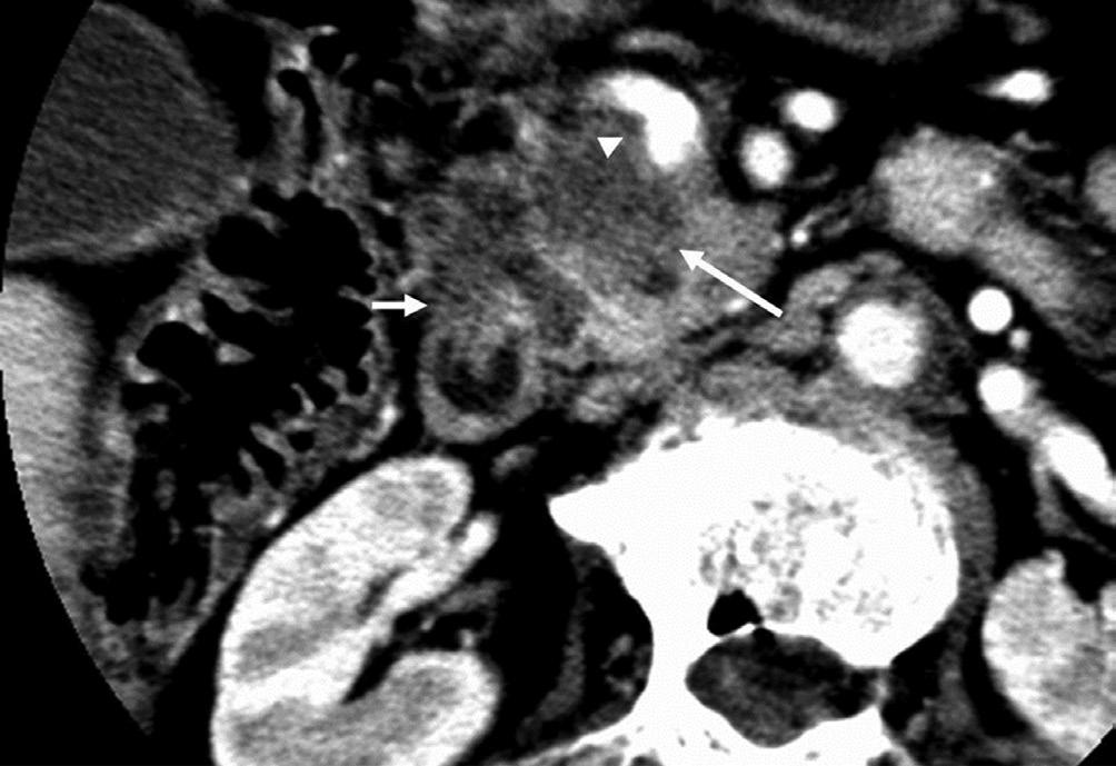 and/or common bile duct (CBD). On CT, it often manifests as a low-density mass on triple phase (arterial and portal) contrast enhanced CT.