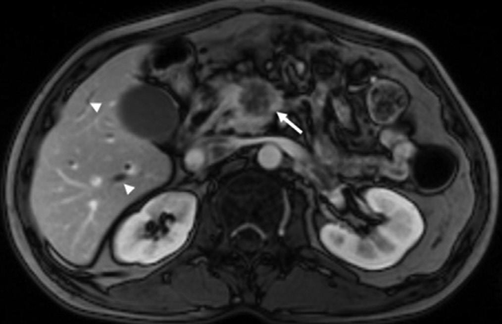 Fat-suppressed T1-weighted image improves the contrast between tumor (long