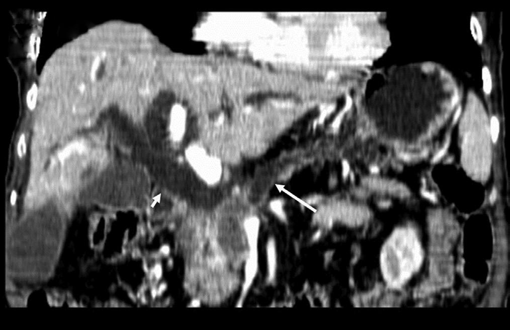 mass (arrow) in the pancreatic head is demonstrated at port vein phase of
