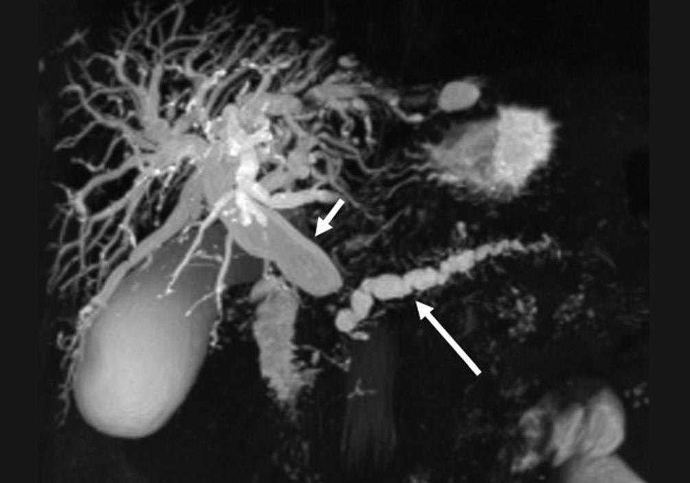 Dilatation of intrahepatic bile ducts (arrowheads) is also revealed Figure 8