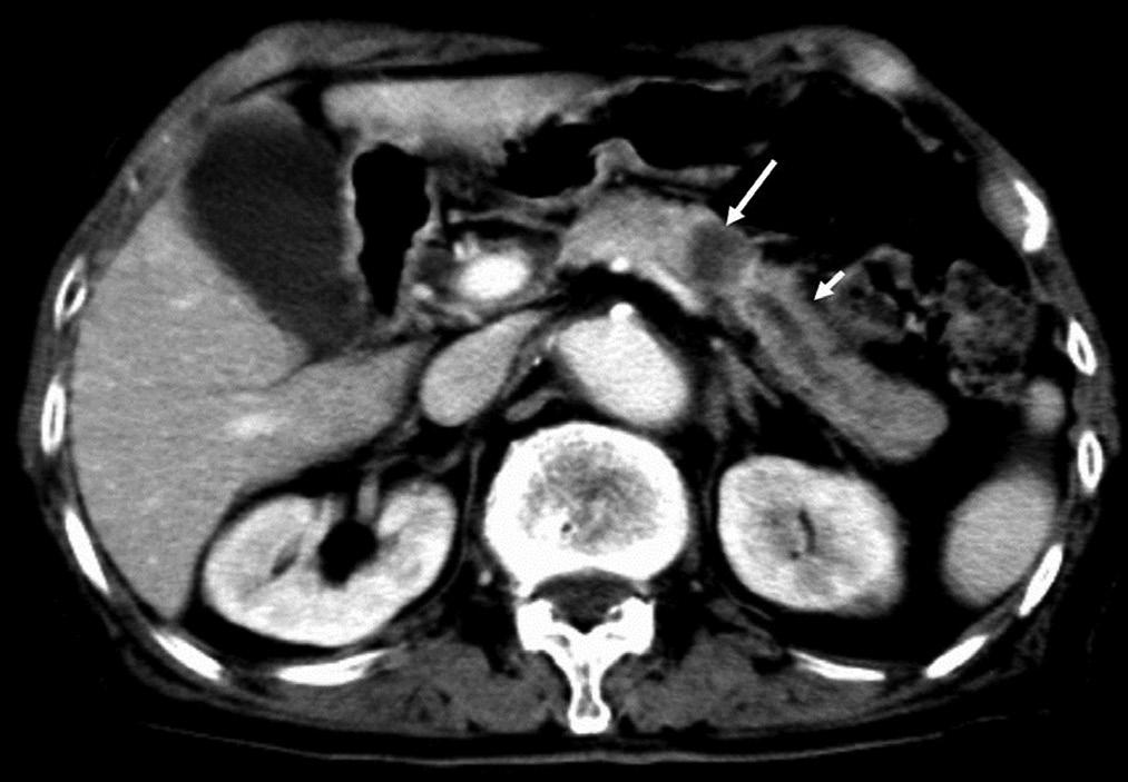 A pancreatic adenocarcinoma in the head of the pancreas results in dilatation of