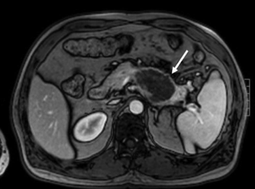 A unilocular cystic mass (arrow) locates in the body of the pancreas.