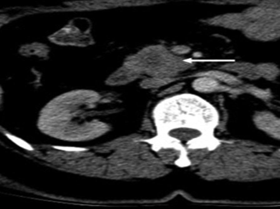 dilation of pancreatic duct and bile duct a focal mass without dilation of upstream pancreatic duct. This phenomenon can be contributed to anatomic variation of pancreatic or bile ducts.