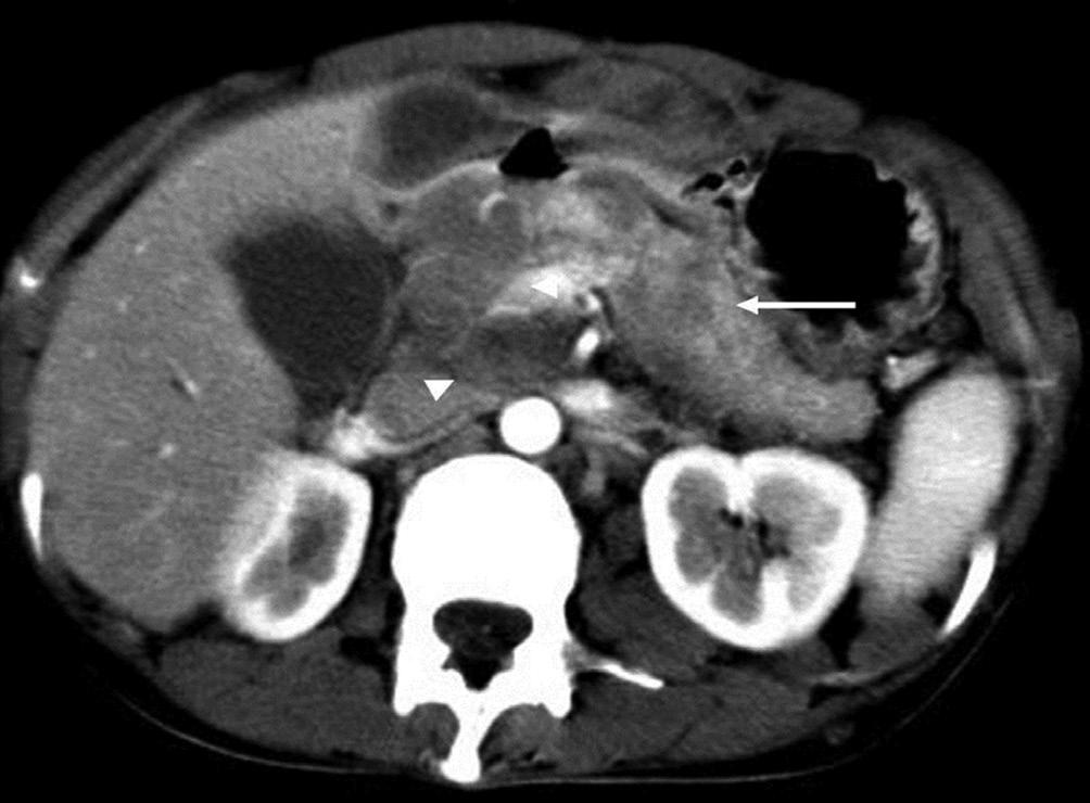 An infiltrative pancreatic mass (arrow) is noted in the body and the tail of the pancreas. Note the metastatic foci within the liver (arrowheads) adenocarcinoma (Figure 17).