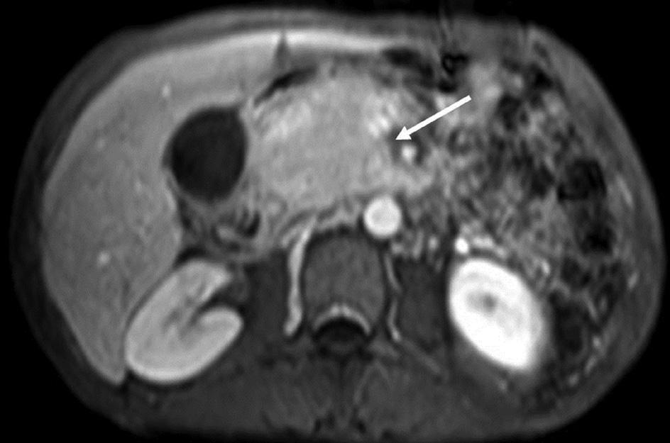 Figure 19 A case of neuroendocrine tumor of the pancreas.