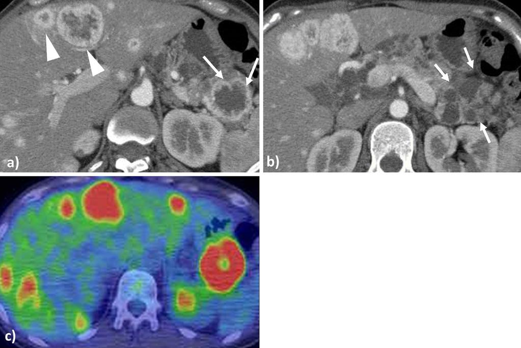 Figure 1. Images on the first admission. a: Computed tomography (CT) showed a hyper-vascular mass with a hypo-vascular lesion in the center of the pancreatic tail (arrow) and liver masses (arrowhead).