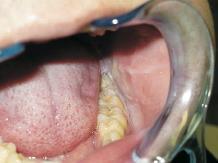 Aspects of Clinical Trial of Wisdom Teeth The position of the tooth crown The