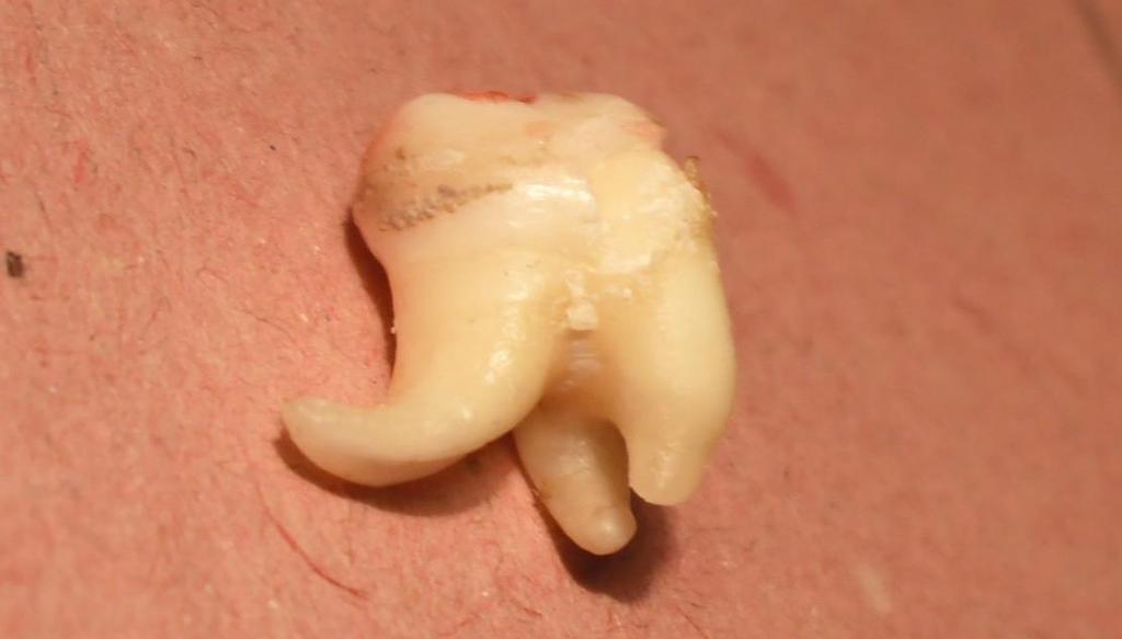 The shape of tooth crown,