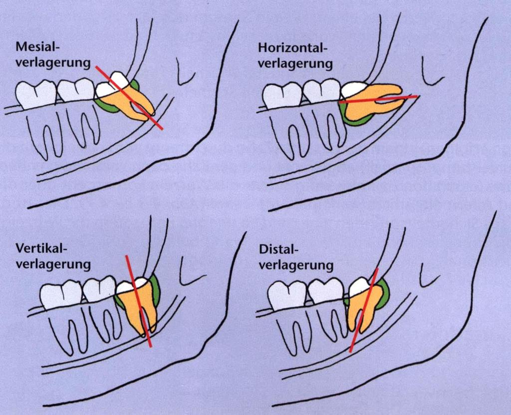 Aspects of Radiological Examination of Lower Wisdom Teeth The relationship between the crown and the second molar tooth,