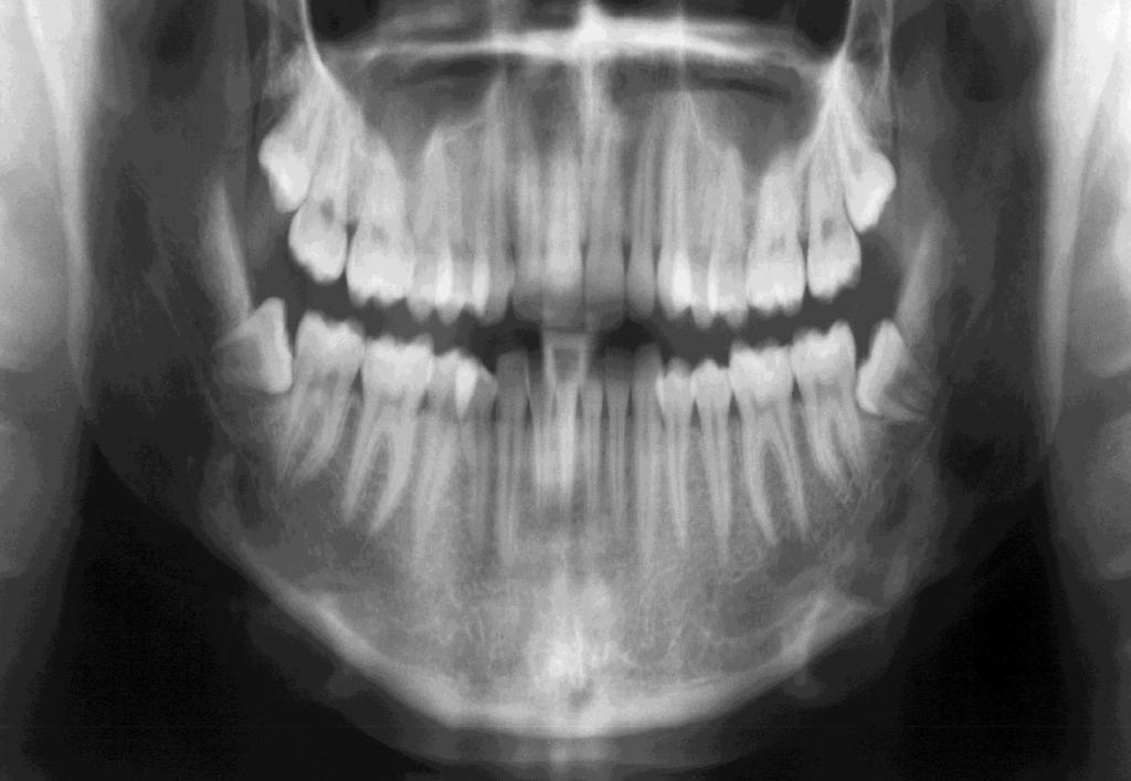 Complications of Wisdom Tooth surgery Postoperative Inflammation After surgery removal of wisdom tooth there is relatively high chance of subsequent inflammation (0.8 to 7.8%).
