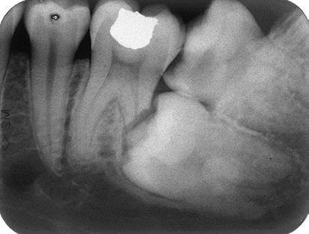 Tooth surgery