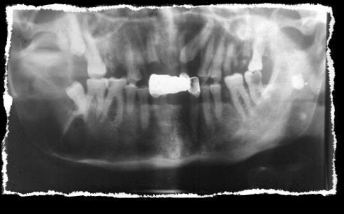 tooth 48 CBCT- radiogram Huge