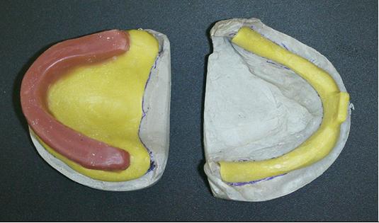 Fig. 1. Individual trays made for the particular purpose to determinate the vertical dimension of occlusion by the phonetic method. Upper rim made from pink wax Fig. 2.