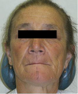 Fig. 6. Facial aspect before treatment that is relatively easy to be performed and got a widespread support.