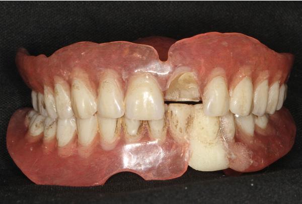 Therapeutic process Figure 1. Old complete denture.
