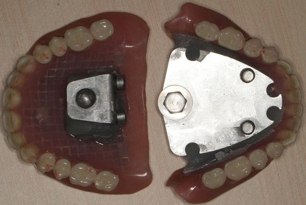 During the complete denture try-in, the patient felt comfortable during mastication and relaxation without the sense of suffocation.