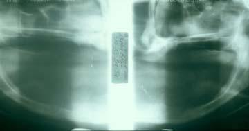 Type IV Residual vertical bone height of 10 mm or