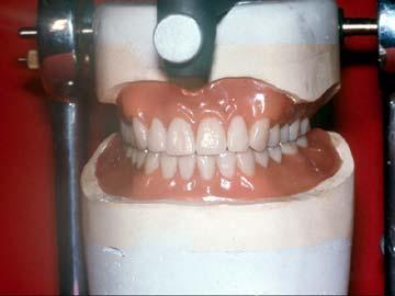 Class I Maxillomandibular relationship allows tooth position that
