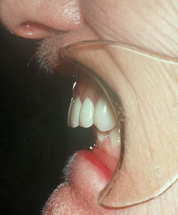 Class II Maxillomandibular relationship requires tooth position outside the normal ridge relation in order to attain phonetics and articulation; i.