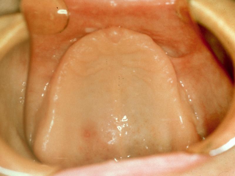 Loss of anterior labial vestibule Prominent midline suture Maxillary palatal and/or lateral tori with bony undercuts that do not affect the posterior extension of the denture base Hyperplastic,