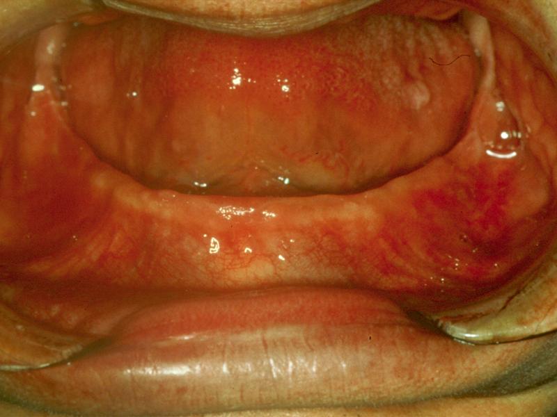 Type A Adequate attached mucosal base without undue