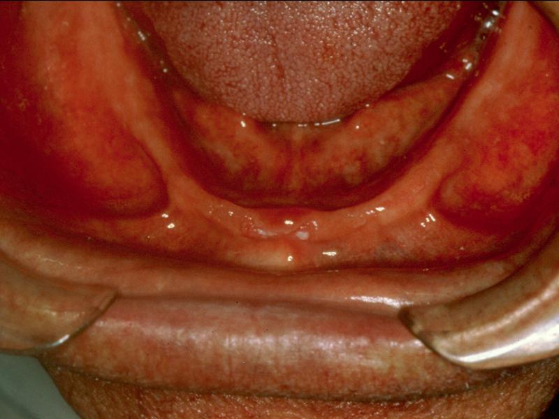 Type B Adequate attached mucosal base in all regions except
