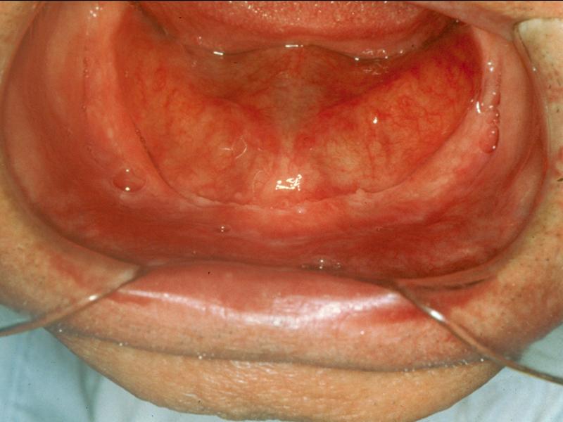 Type C Adequate attached mucosal base in all regions except anterior buccal and