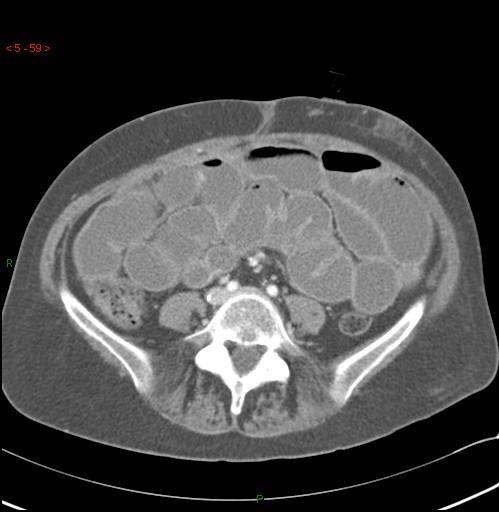 CT scan: intestinal occlusion Fig. 7 CT scan: Intestinal Occlusion 2.3. What are the Crucial Issues to Consider before Starting HPN in a Patient with an Incurable Cancer?