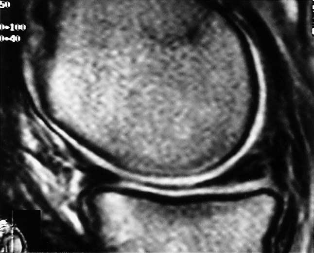 362 E. Pessis et al.: Knee osteoarthritis: arthroscopy and MRI providing informed consent.