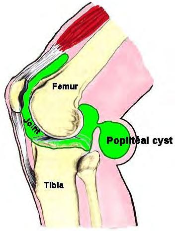 39 A popliteal cyst (also called a Baker s cyst) is