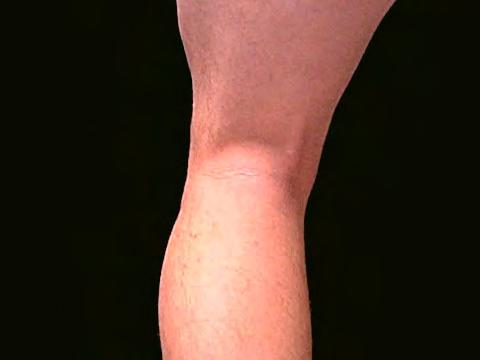 61 The word popliteal refers to