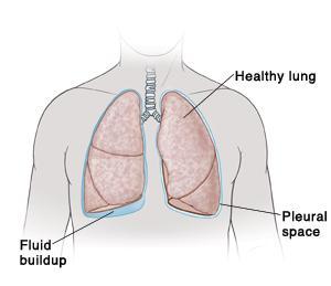 Respiratory System - Pleural Space Pleural space: fluid-filled space between the pleural membrane and the chest wall Reduces friction