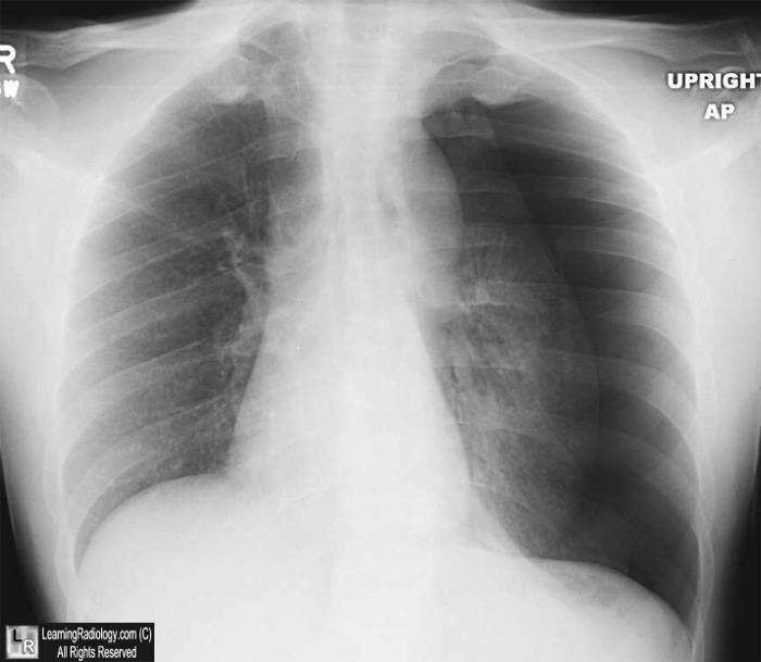 pneumothorax air fills