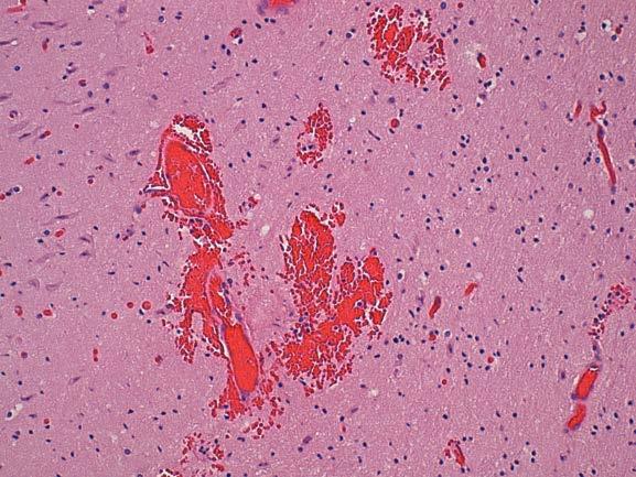 magnification) and parenchymal hemorrhage (100x